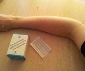 Acupuncture Tips for First-Timers