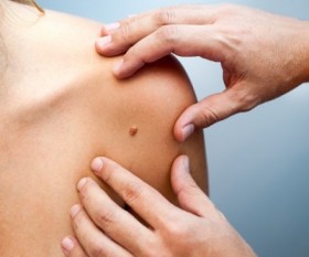 Facts About Skin Mole Removal