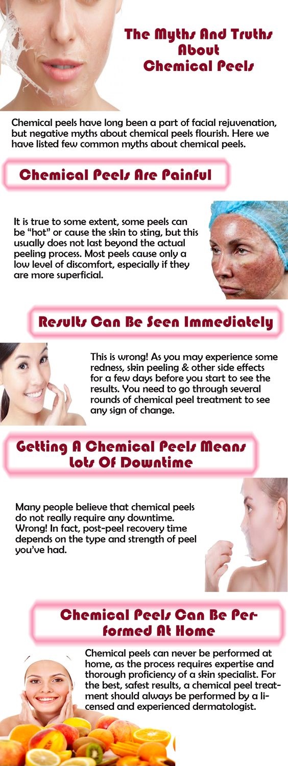 Chemical Peels Myths and Facts